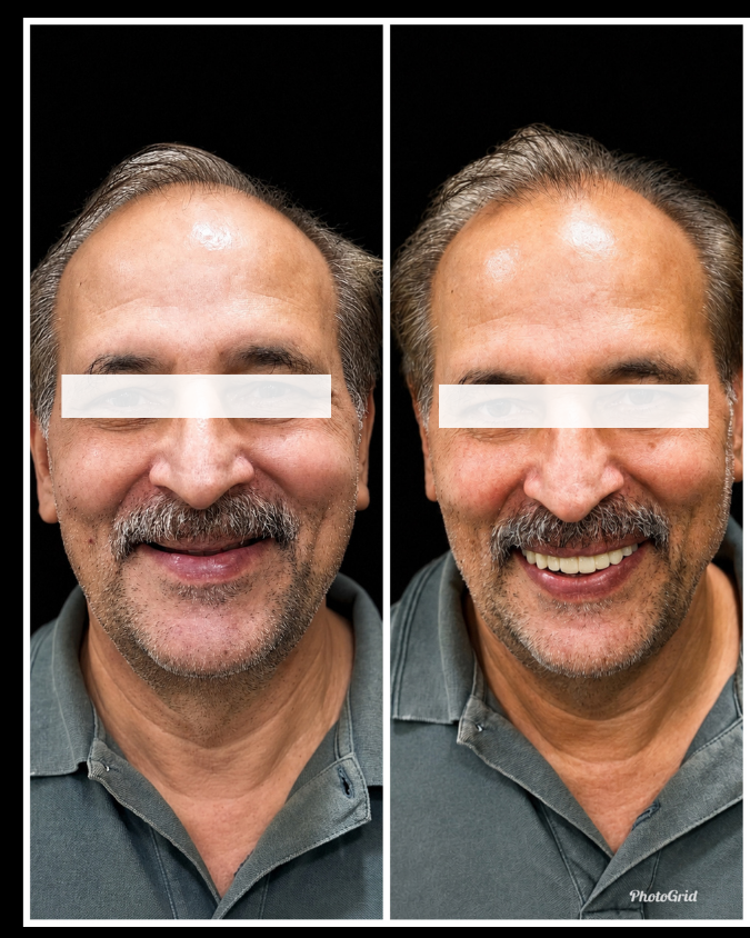 Smile Makeover Result