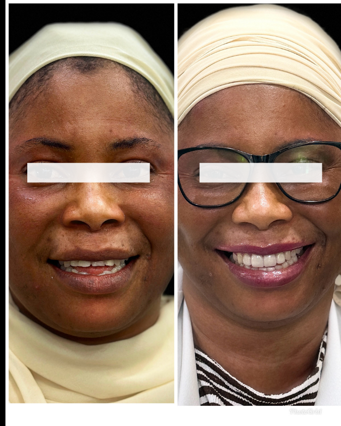 Dental Implant Result