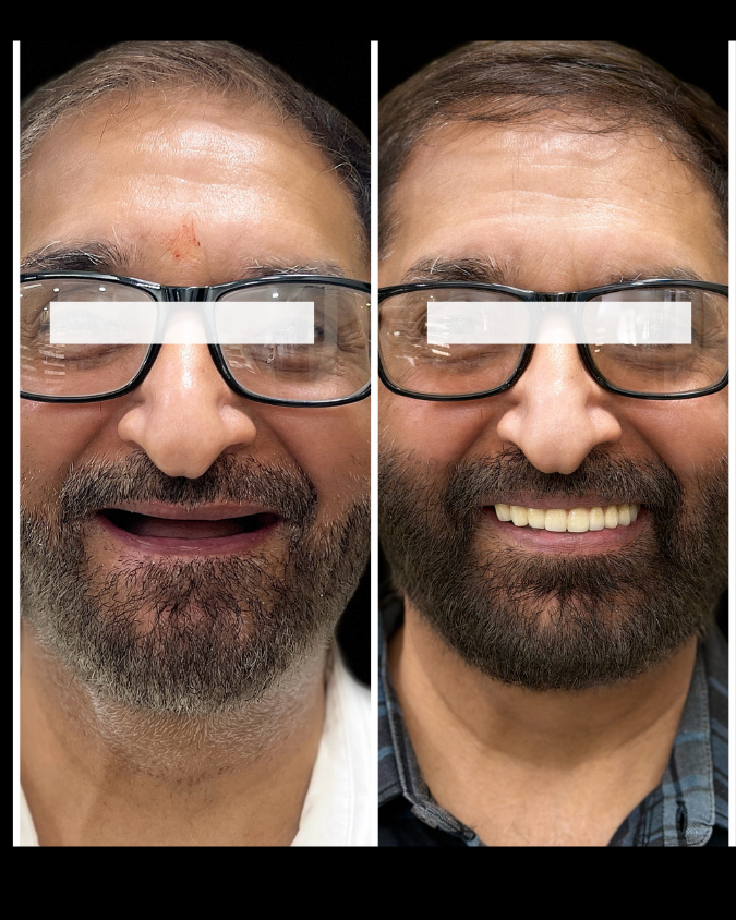 Teeth Whitening Result