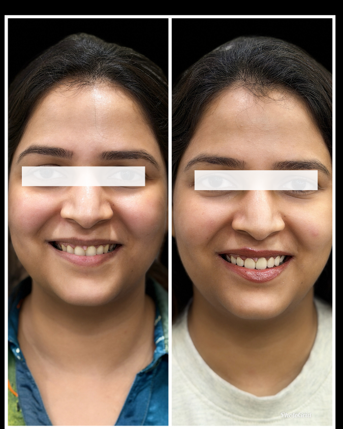 Full Mouth Rehabilitation